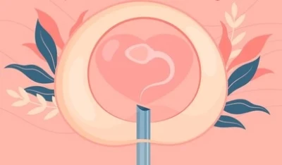 IVF (In-vitro Fertilization)