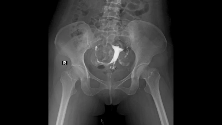 Hysterosalpingography Test (HSG): Purpose, Procedure & What to Expect